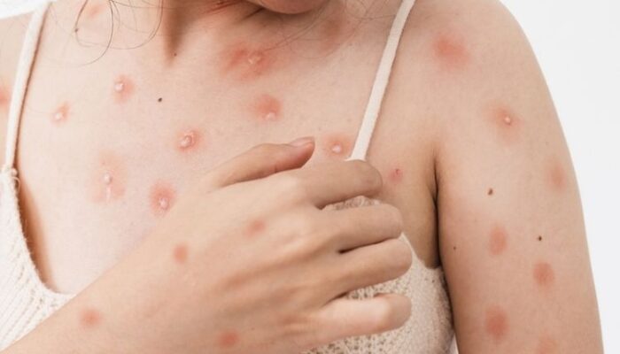 Cacar Monyet Mudah Menular, Warga Padang Diimbau Terapkan PHBS dan Germas